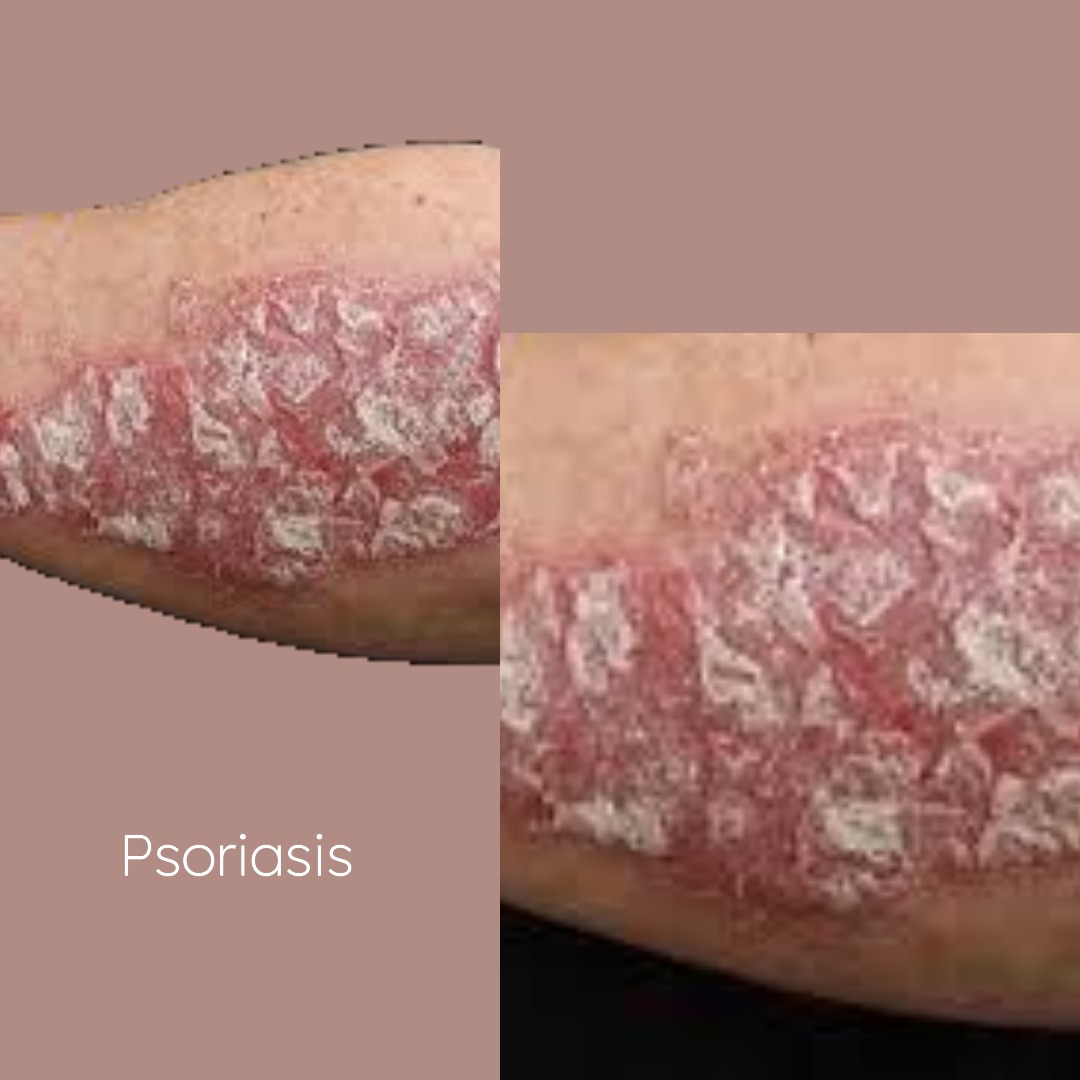 Join the Fight Against Psoriasis Join the Fight Against Psoriasis