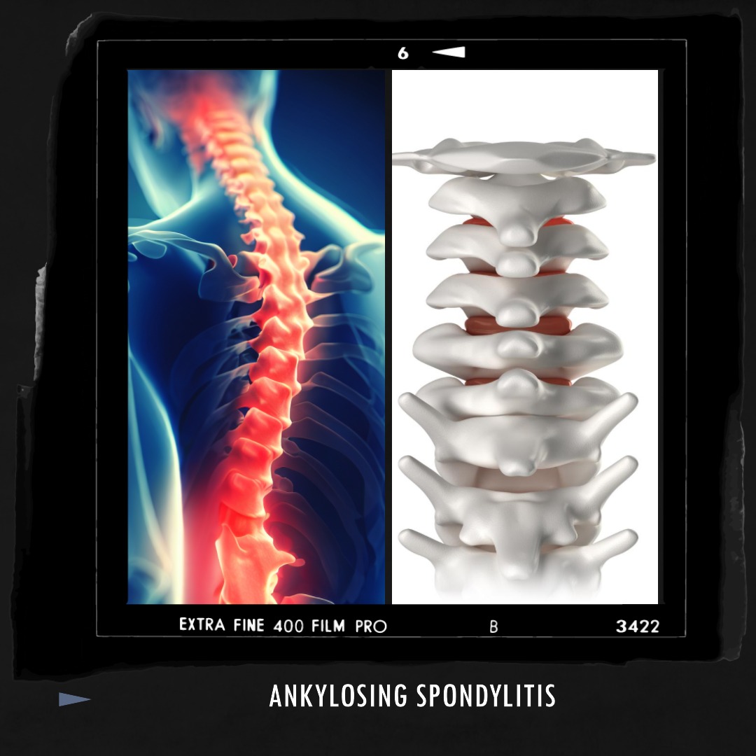 Learn About Ankylosing Spondylitis Learn About Ankylosing Spondylitis