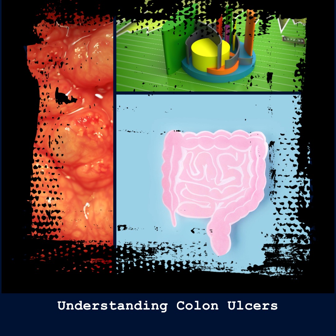 Understanding Colon Ulcers Understanding Colon Ulcers