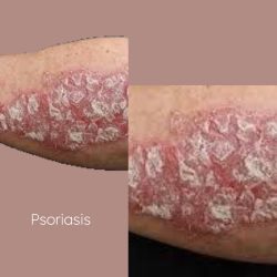 Join the Fight Against Psoriasis